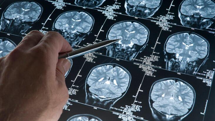 Alzheimer’ın beyindeki tahribatını yavaşlatan ilk ilaç: Lecanemab